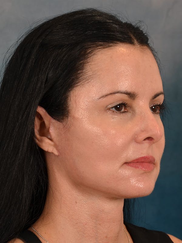 Laser Skin Resurfacing Before & After Gallery - Patient 141925 - Image 8