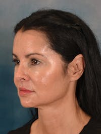 Deep Plane Facelift Before & After Gallery - Patient 148969 - Image 1
