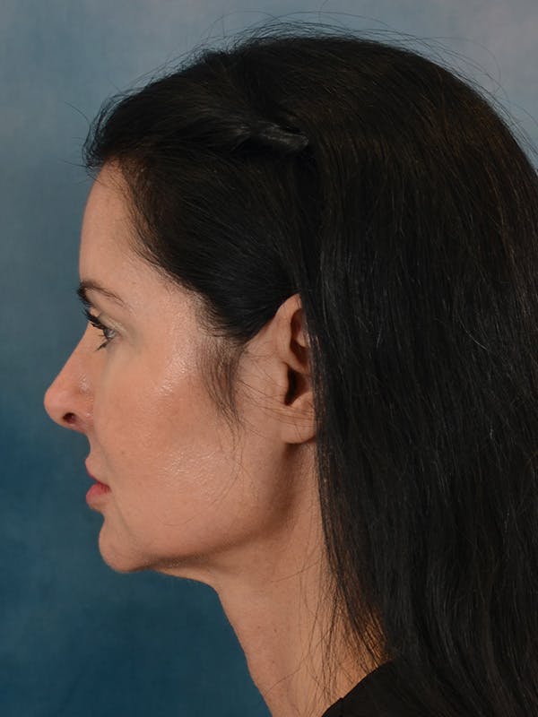 Laser Skin Resurfacing Before & After Gallery - Patient 141925 - Image 5