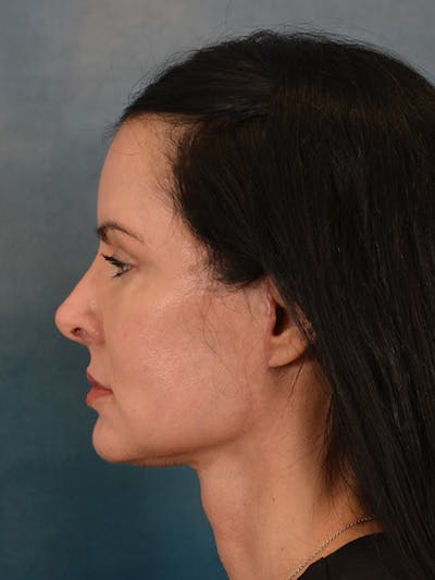 Laser Skin Resurfacing Before & After Gallery - Patient 141925 - Image 6