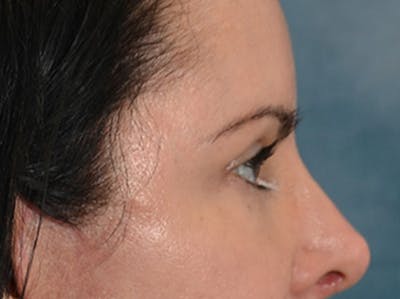 Eyelid Lift Before & After Gallery - Patient 383716 - Image 6