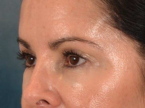 Eyelid Lift Before & After Gallery - Patient 383716 - Image 7