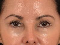 Eyelid Lift Before & After Gallery - Patient 383716 - Image 1