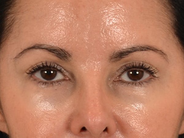 Eyelid Lift Before & After Gallery - Patient 383716 - Image 1