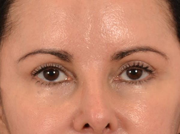 Eyelid Lift Before & After Gallery - Patient 383716 - Image 2