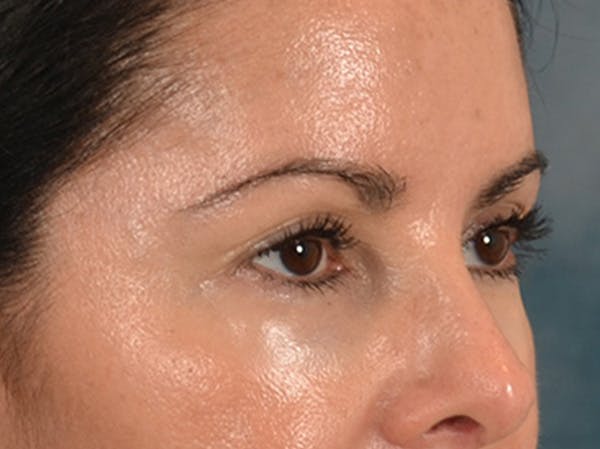 Eyelid Lift Before & After Gallery - Patient 383716 - Image 3