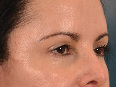 Eyelid Lift Before & After Gallery - Patient 383716 - Image 4