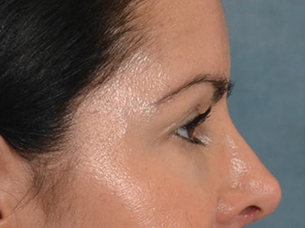 Eyelid Lift Before & After Gallery - Patient 383716 - Image 5