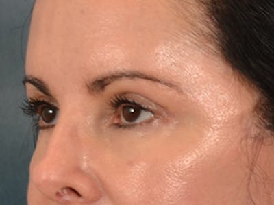 Eyelid Lift Before & After Gallery - Patient 383716 - Image 8