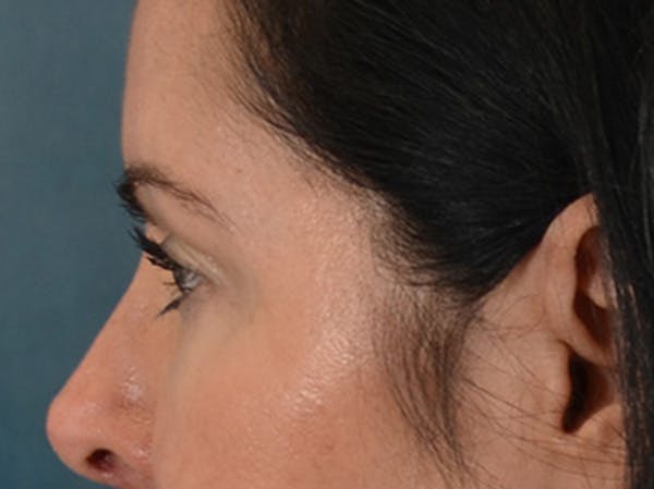 Eyelid Lift Before & After Gallery - Patient 383716 - Image 9