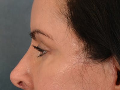 Eyelid Lift Before & After Gallery - Patient 383716 - Image 10