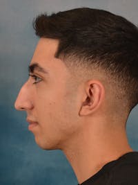 Rhinoplasty Before & After Gallery - Patient 544468 - Image 1