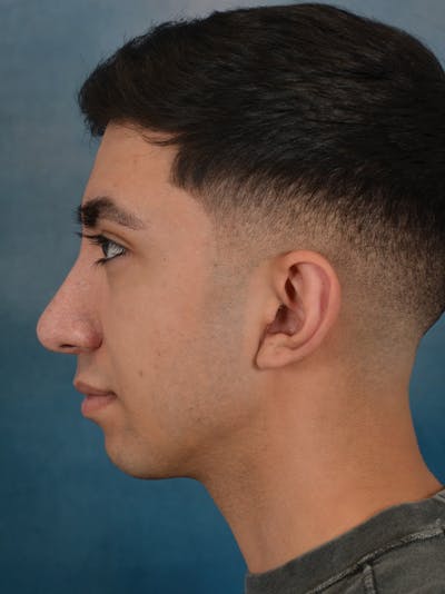 Rhinoplasty Before & After Gallery - Patient 544468 - Image 2
