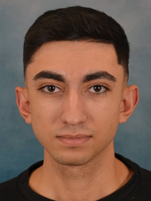 Rhinoplasty Before & After Gallery - Patient 544468 - Image 5