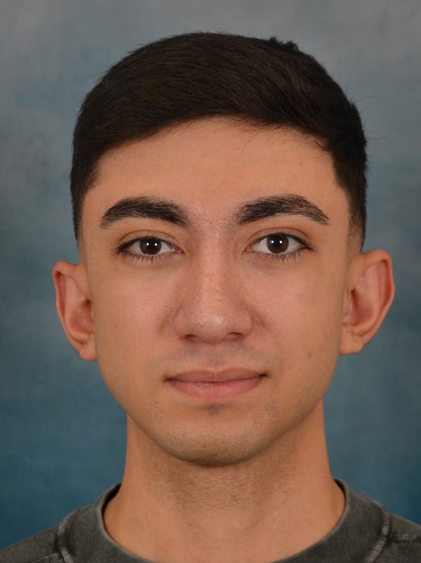 Rhinoplasty Before & After Gallery - Patient 544468 - Image 6