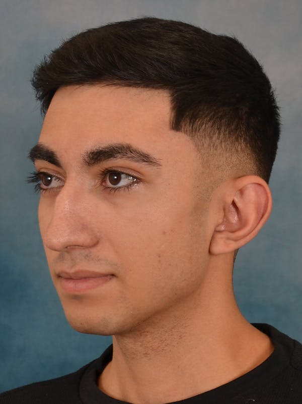 Rhinoplasty Before & After Gallery - Patient 544468 - Image 3
