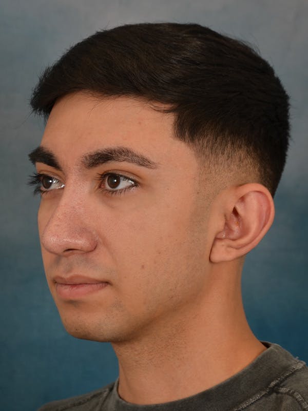 Rhinoplasty Before & After Gallery - Patient 544468 - Image 4
