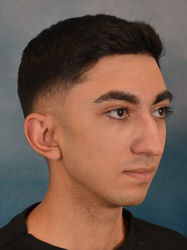Rhinoplasty Before & After Gallery - Patient 544468 - Image 7