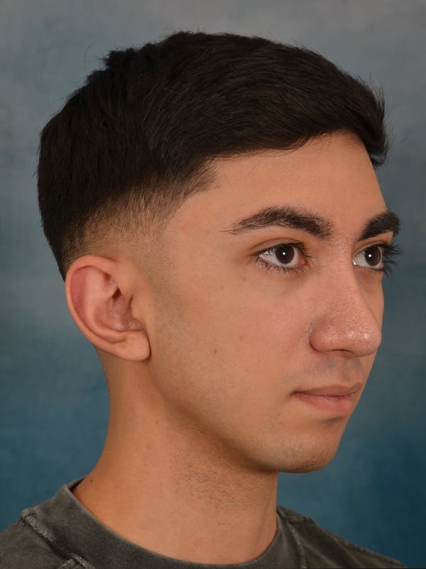 Rhinoplasty Before & After Gallery - Patient 544468 - Image 8