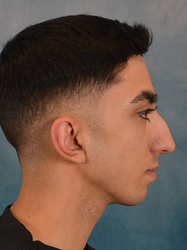 Rhinoplasty Before & After Gallery - Patient 544468 - Image 9