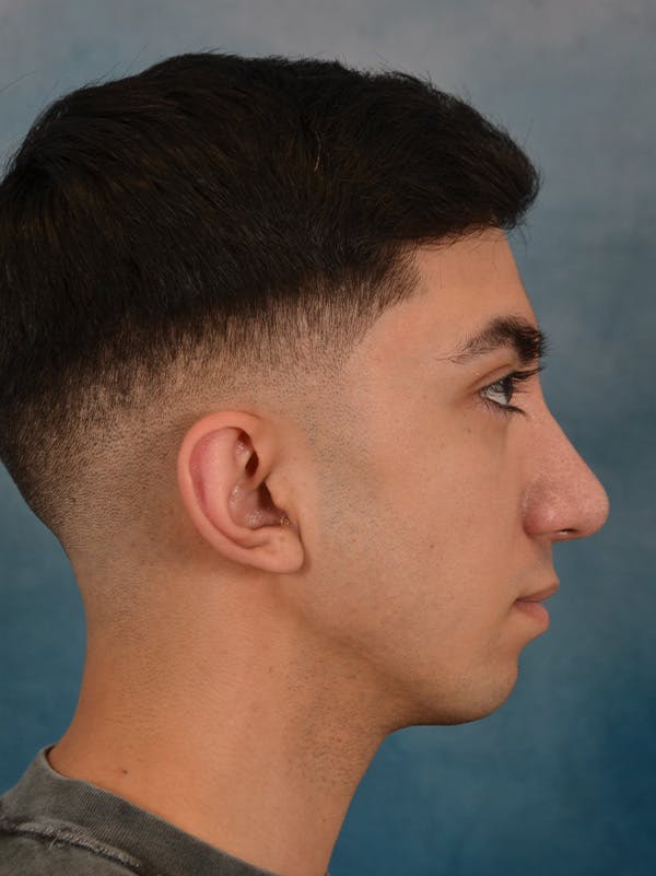 Rhinoplasty Before & After Gallery - Patient 544468 - Image 10