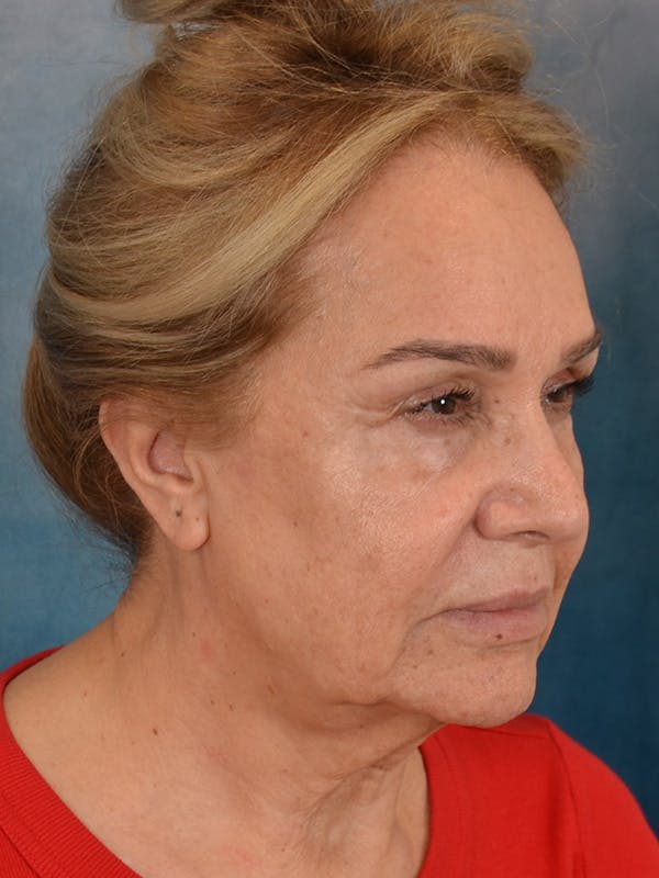 Deep Plane Facelift Before & After Gallery - Patient 148969 - Image 7