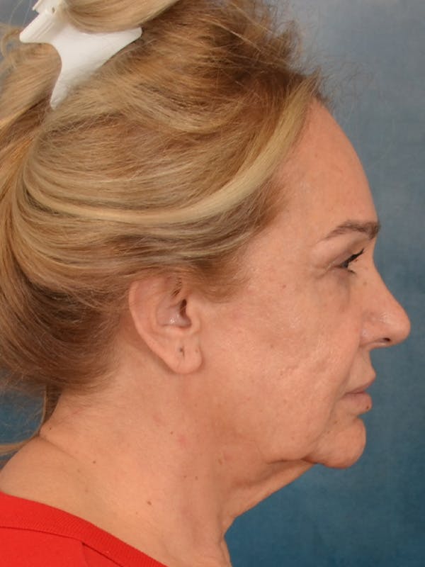 Fat Transfer Before & After Gallery - Patient 195218 - Image 9