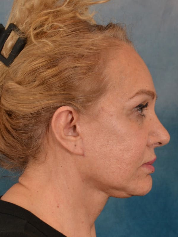 Fat Transfer Before & After Gallery - Patient 195218 - Image 10