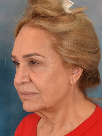 Deep Plane Facelift Before & After Gallery - Patient 148969 - Image 1