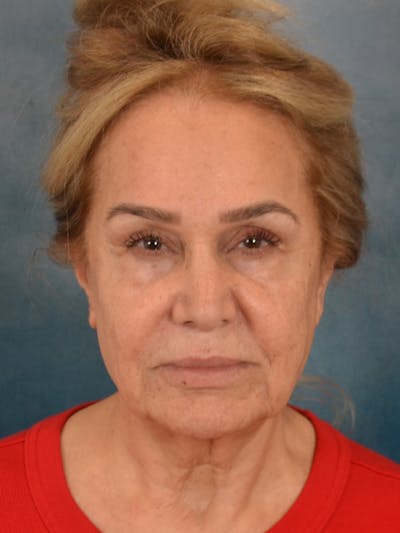 Fat Transfer Before & After Gallery - Patient 195218 - Image 1