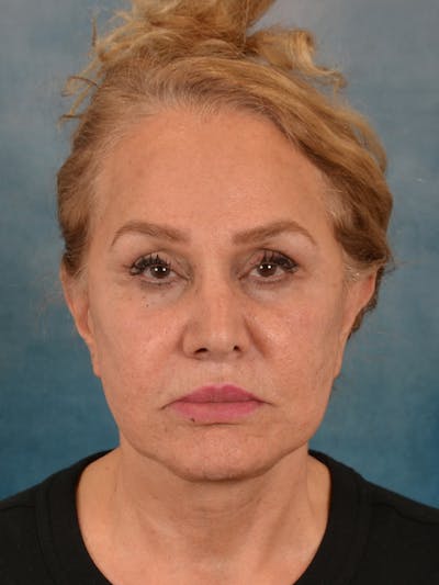 Fat Transfer Before & After Gallery - Patient 195218 - Image 2