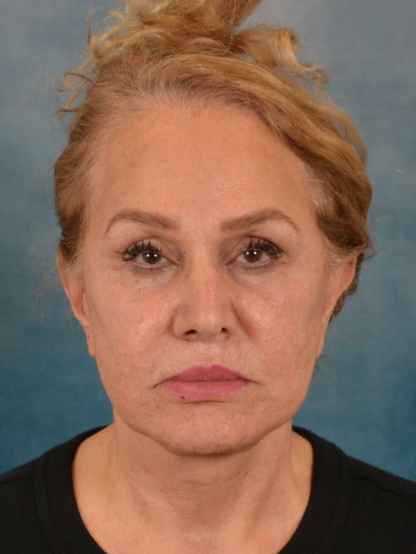 Fat Transfer Before & After Gallery - Patient 195218 - Image 2
