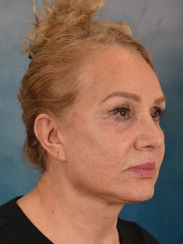 Fat Transfer Before & After Gallery - Patient 195218 - Image 8