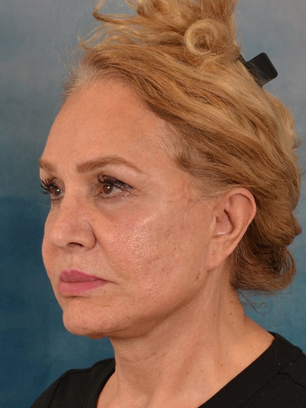 Deep Plane Facelift Before & After Gallery - Patient 148969 - Image 2