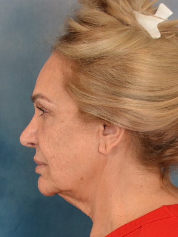 Fat Transfer Before & After Gallery - Patient 195218 - Image 5