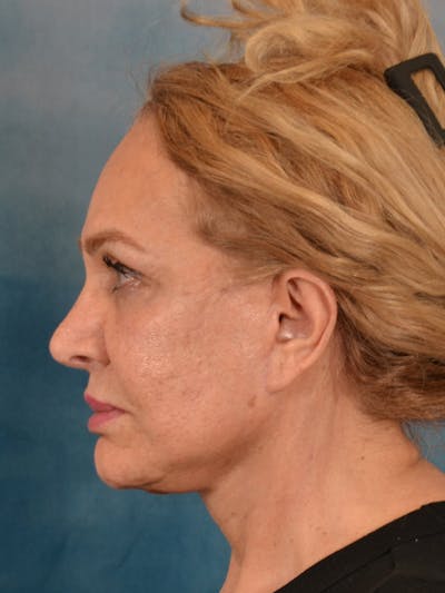 Fat Transfer Before & After Gallery - Patient 195218 - Image 6