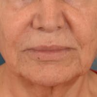 Lip Lift Before & After Gallery - Patient 302689 - Image 1
