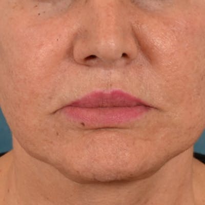 Lip Lift Before & After Gallery - Patient 302689 - Image 2