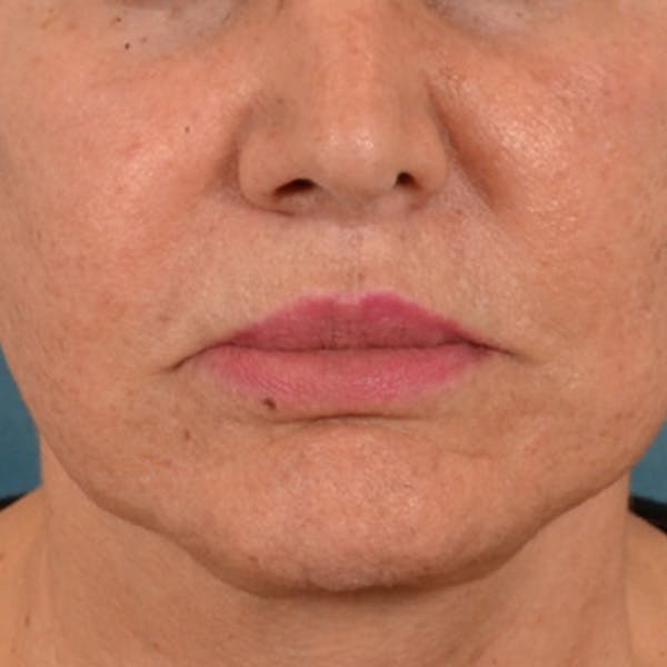 Lip Lift Before & After Gallery - Patient 302689 - Image 2