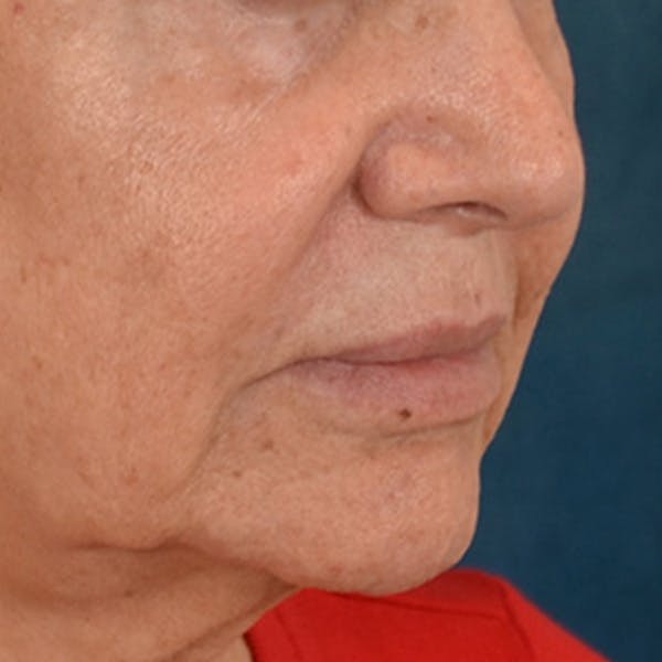 Lip Lift Before & After Gallery - Patient 302689 - Image 3