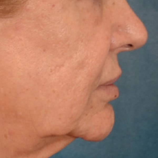 Lip Lift Before & After Gallery - Patient 302689 - Image 5