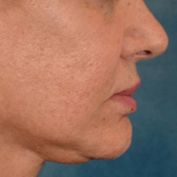 Lip Lift Before & After Gallery - Patient 302689 - Image 6