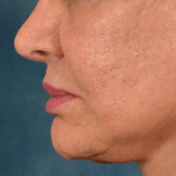 Lip Lift Before & After Gallery - Patient 302689 - Image 10