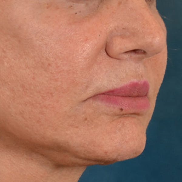 Lip Lift Before & After Gallery - Patient 302689 - Image 4