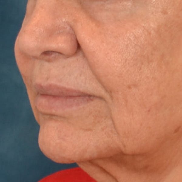 Lip Lift Before & After Gallery - Patient 302689 - Image 7