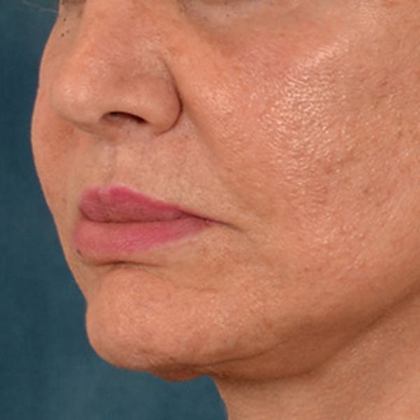 Lip Lift Before & After Gallery - Patient 302689 - Image 8