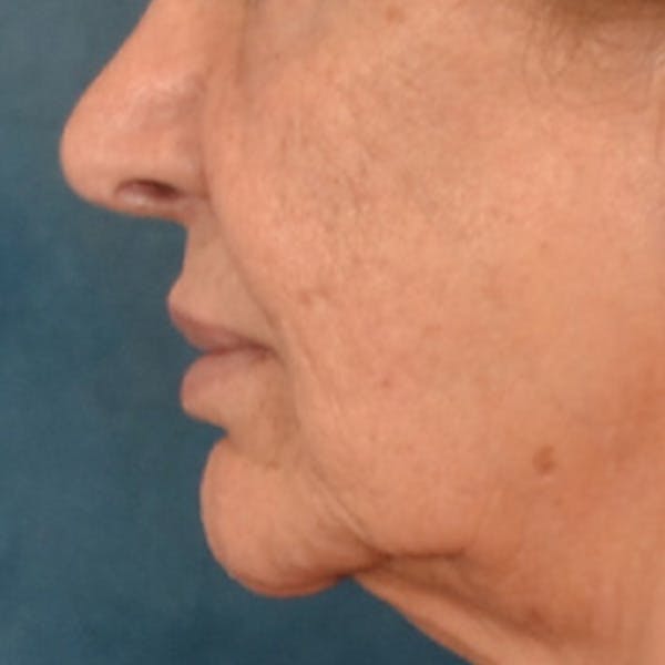 Lip Lift Before & After Gallery - Patient 302689 - Image 9