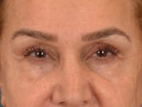 Eyelid Lift Before & After Gallery - Patient 453896 - Image 1