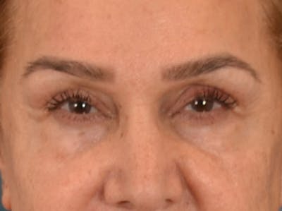 Eyelid Lift Before & After Gallery - Patient 453896 - Image 1