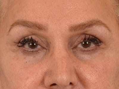 Eyelid Lift Before & After Gallery - Patient 453896 - Image 2
